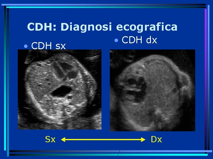 CDH: Diagnosi ecografica • CDH sx Sx • CDH dx Dx 