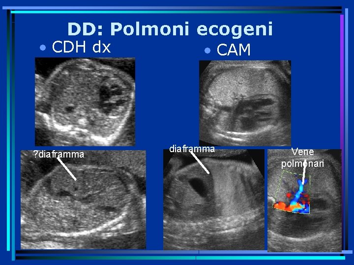 DD: Polmoni ecogeni • CDH dx ? diaframma • CAM diaframma Vene polmonari 