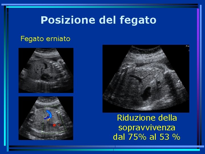 Posizione del fegato Fegato erniato Riduzione della sopravvivenza dal 75% al 53 % 