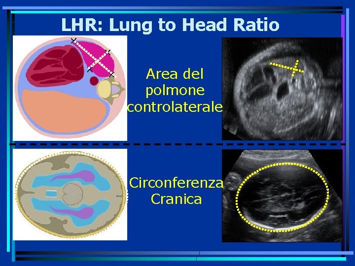 LHR: Lung to Head Ratio Area del polmone controlaterale Circonferenza Cranica 