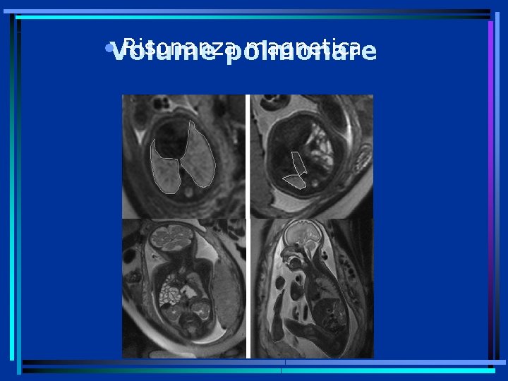 • Volume Risonanza magnetica polmonare 