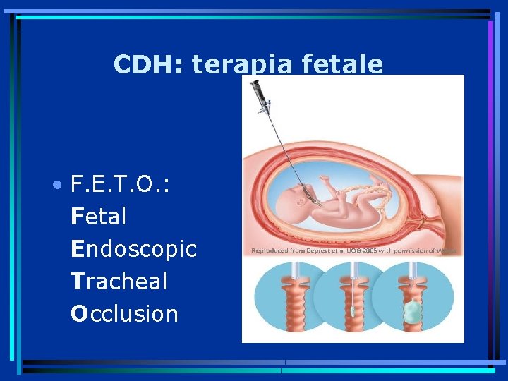 CDH: terapia fetale • F. E. T. O. : Fetal Endoscopic Tracheal Occlusion 