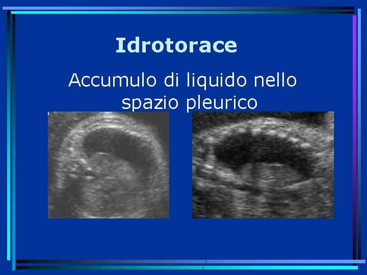 Idrotorace Accumulo di liquido nello spazio pleurico 