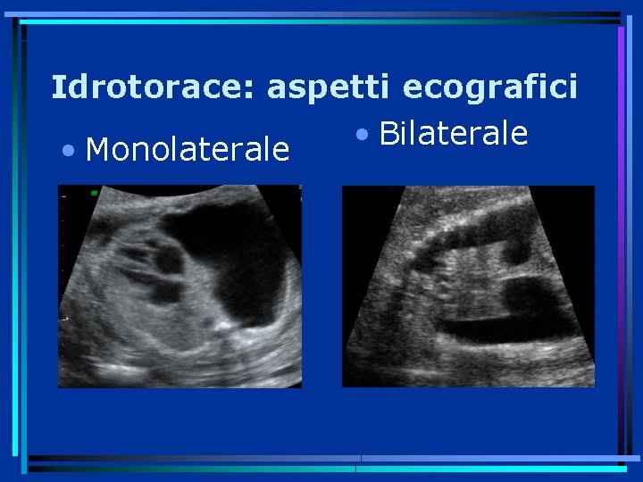 Idrotorace: aspetti ecografici • Bilaterale • Monolaterale 