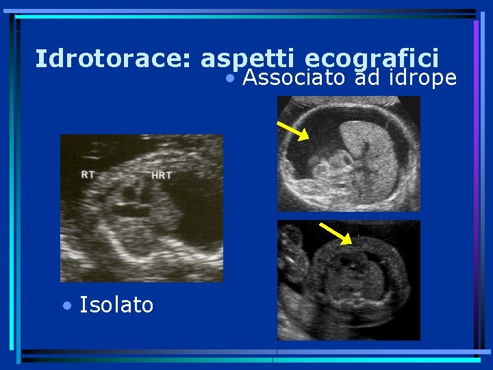 Idrotorace: aspetti ecografici • Associato ad idrope • Isolato 