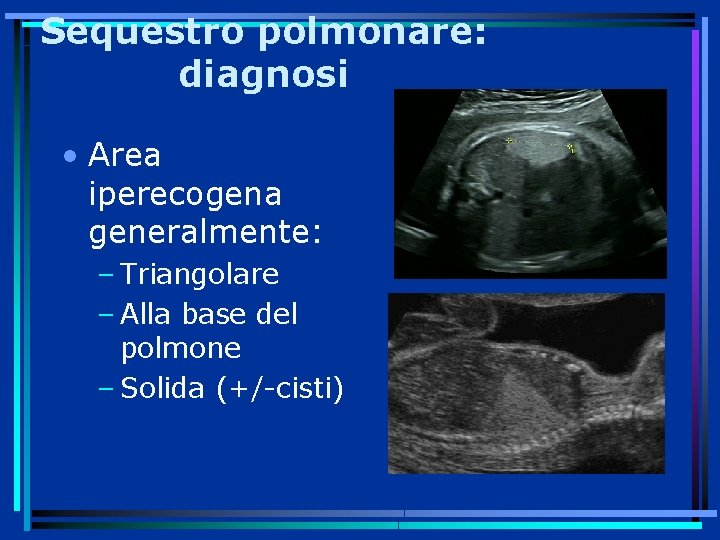 Sequestro polmonare: diagnosi • Area iperecogena generalmente: – Triangolare – Alla base del polmone