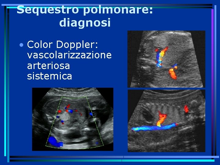 Sequestro polmonare: diagnosi • Color Doppler: vascolarizzazione arteriosa sistemica 