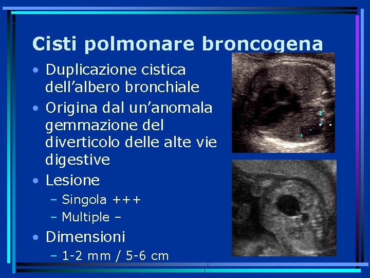 Cisti polmonare broncogena • Duplicazione cistica dell’albero bronchiale • Origina dal un’anomala gemmazione del