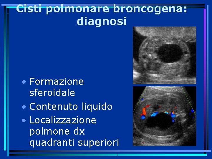 Cisti polmonare broncogena: diagnosi • Formazione sferoidale • Contenuto liquido • Localizzazione polmone dx