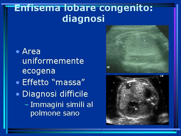 Enfisema lobare congenito: diagnosi • Area uniformemente ecogena • Effetto “massa” • Diagnosi difficile