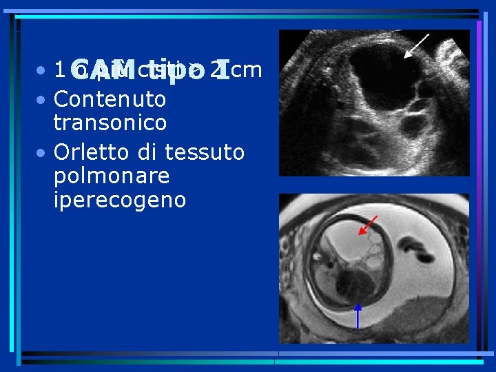  • 1 CAM o più cisti 2 Icm tipo • Contenuto transonico •