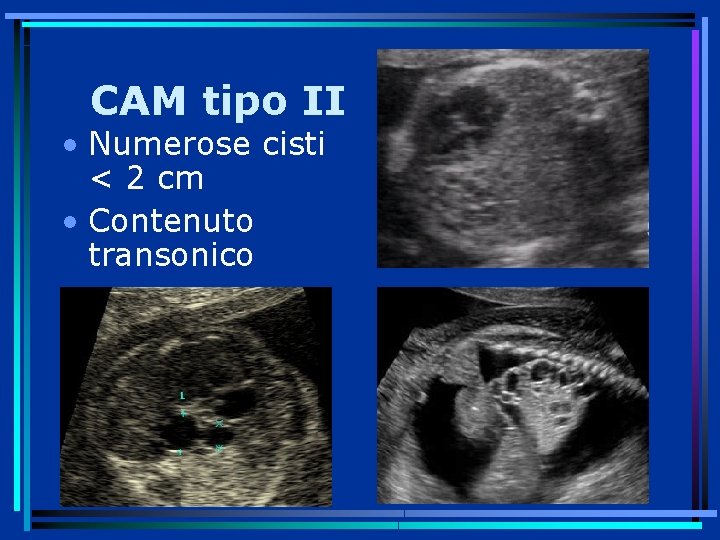 CAM tipo II • Numerose cisti < 2 cm • Contenuto transonico 