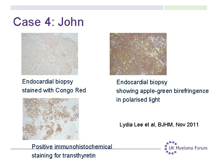 Case 4: John Endocardial biopsy stained with Congo Red Endocardial biopsy showing apple-green birefringence Case 4: John Endocardial biopsy stained with Congo Red Endocardial biopsy showing apple-green birefringence