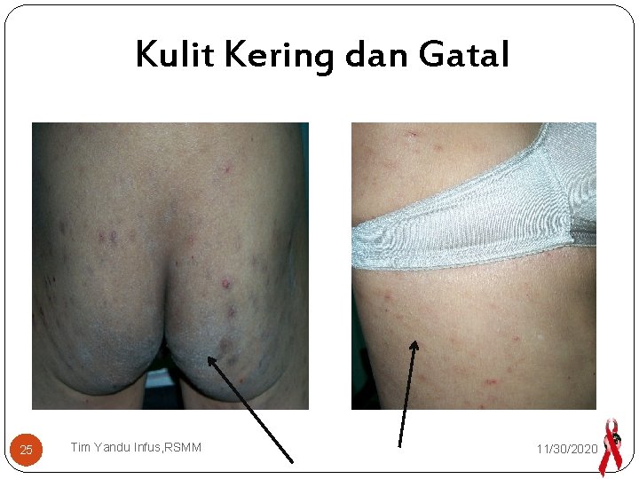 Kulit Kering dan Gatal 25 Tim Yandu Infus, RSMM 11/30/2020 