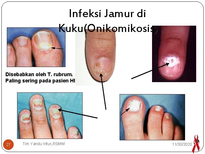 Infeksi Jamur di Kuku(Onikomikosis) Disebabkan oleh T. rubrum. Paling sering pada pasien HIV 27