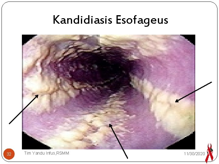 Kandidiasis Esofageus 32 Tim Yandu Infus, RSMM 11/30/2020 