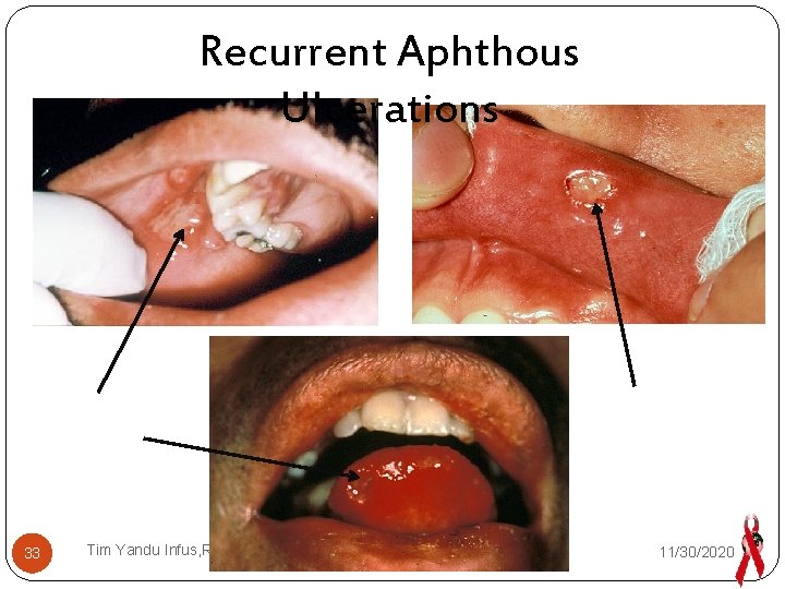 Recurrent Aphthous Ulcerations 33 Tim Yandu Infus, RSMM 11/30/2020 
