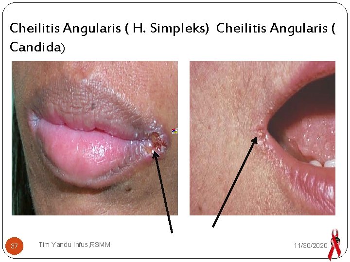 Cheilitis Angularis ( H. Simpleks) Cheilitis Angularis ( Candida) 37 Tim Yandu Infus, RSMM