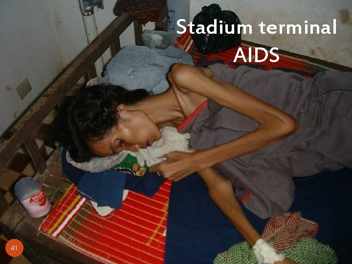 Stadium terminal AIDS 41 Tim Yandu Infus, RSMM 11/30/2020 