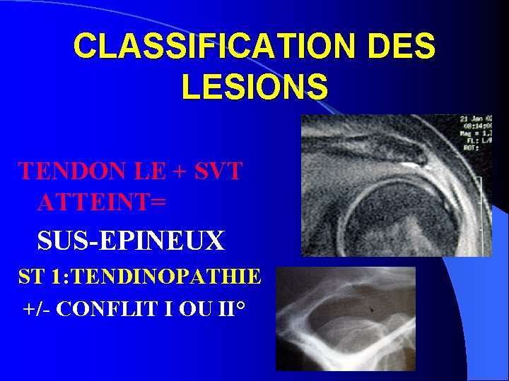 CLASSIFICATION DES LESIONS TENDON LE + SVT ATTEINT= SUS-EPINEUX ST 1: TENDINOPATHIE +/- CONFLIT