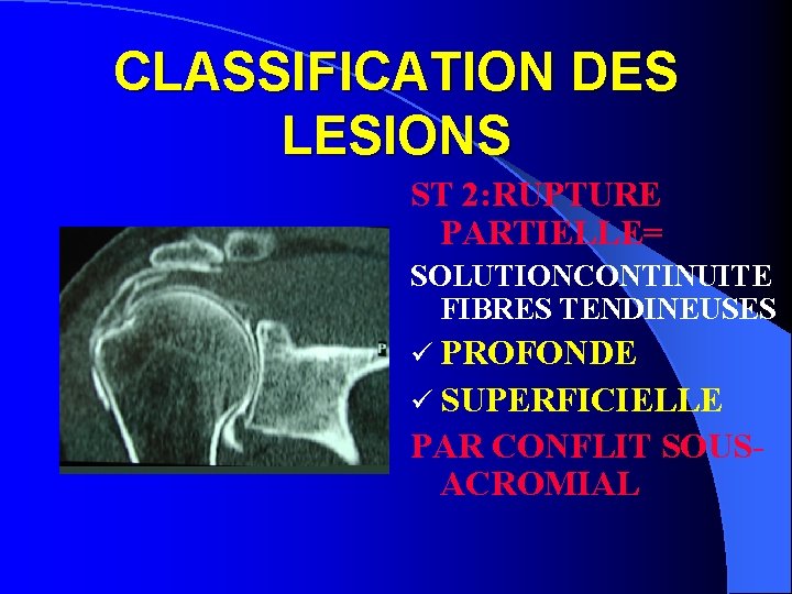 CLASSIFICATION DES LESIONS ST 2: RUPTURE PARTIELLE= SOLUTIONCONTINUITE FIBRES TENDINEUSES ü PROFONDE ü SUPERFICIELLE