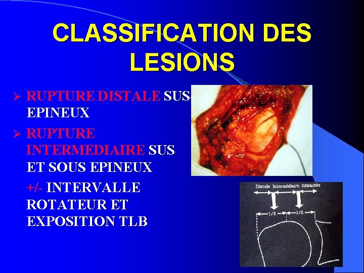 CLASSIFICATION DES LESIONS RUPTURE DISTALE SUSEPINEUX Ø RUPTURE INTERMEDIAIRE SUS ET SOUS EPINEUX +/-