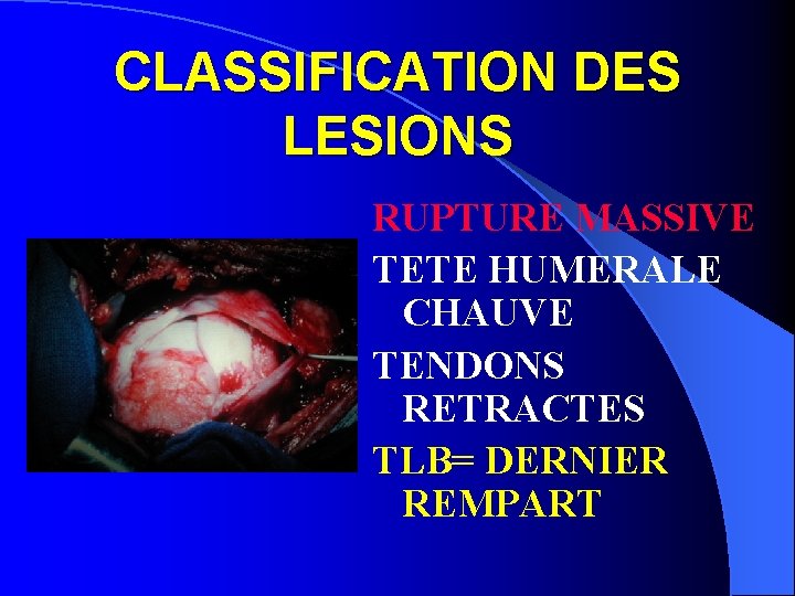 CLASSIFICATION DES LESIONS RUPTURE MASSIVE TETE HUMERALE CHAUVE TENDONS RETRACTES TLB= DERNIER REMPART 