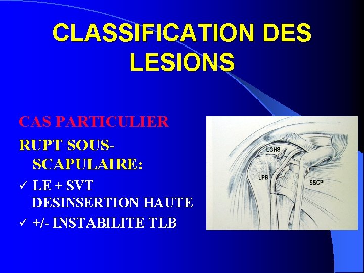 CLASSIFICATION DES LESIONS CAS PARTICULIER RUPT SOUSSCAPULAIRE: LE + SVT DESINSERTION HAUTE ü +/-