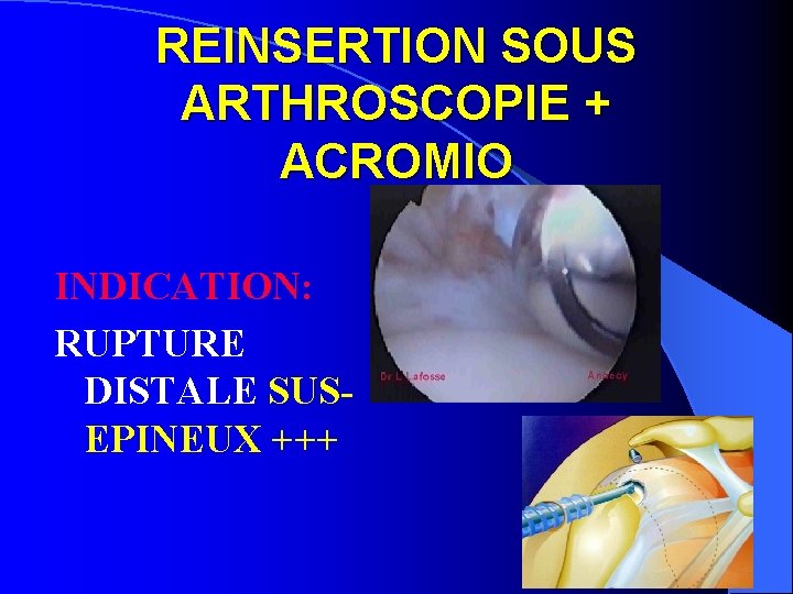 REINSERTION SOUS ARTHROSCOPIE + ACROMIO INDICATION: RUPTURE DISTALE SUSEPINEUX +++ 