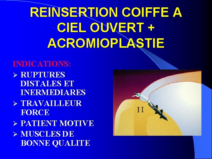 REINSERTION COIFFE A CIEL OUVERT + ACROMIOPLASTIE INDICATIONS: Ø RUPTURES DISTALES ET INERMEDIARES Ø