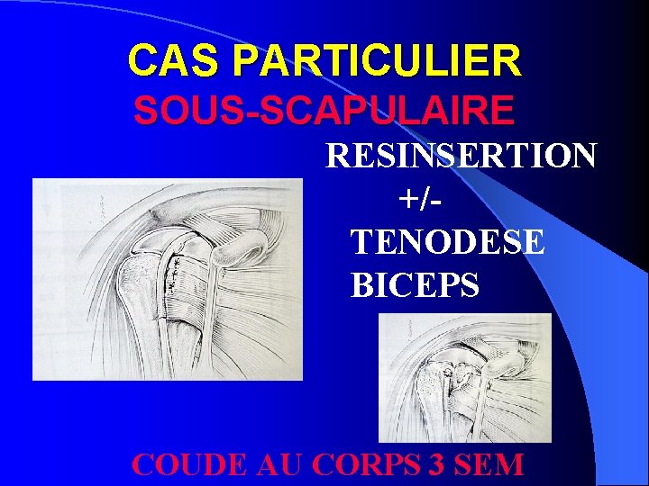 CAS PARTICULIER SOUS-SCAPULAIRE RESINSERTION +/TENODESE BICEPS COUDE AU CORPS 3 SEM 