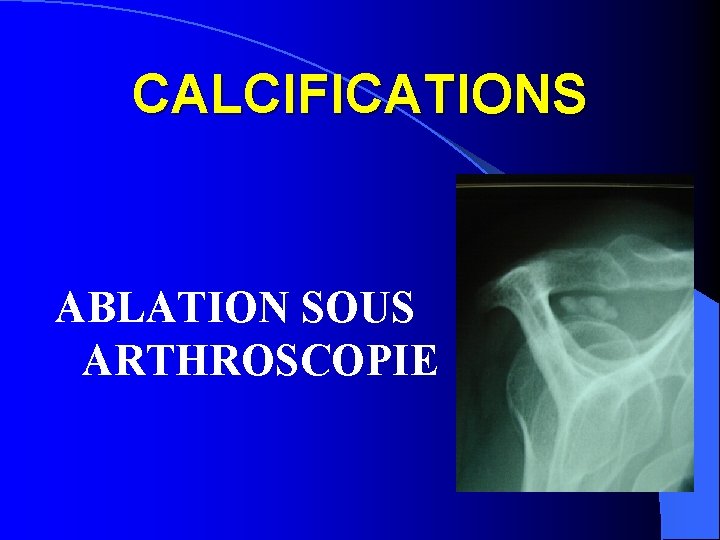 CALCIFICATIONS ABLATION SOUS ARTHROSCOPIE 