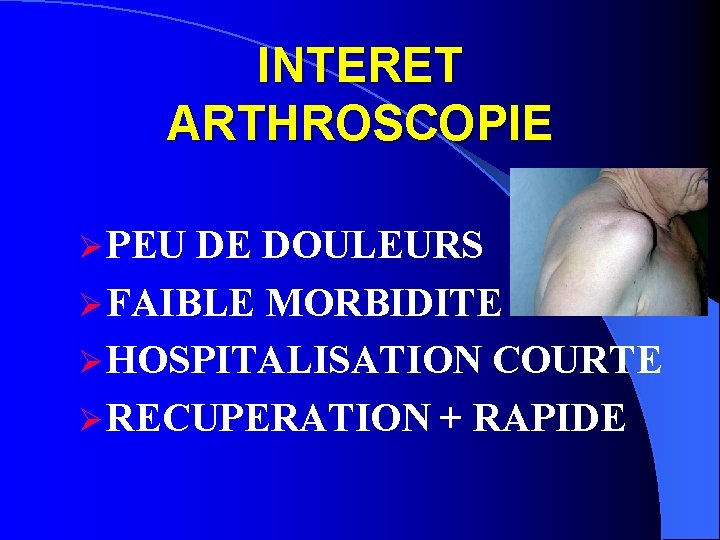 INTERET ARTHROSCOPIE Ø PEU DE DOULEURS Ø FAIBLE MORBIDITE Ø HOSPITALISATION COURTE Ø RECUPERATION
