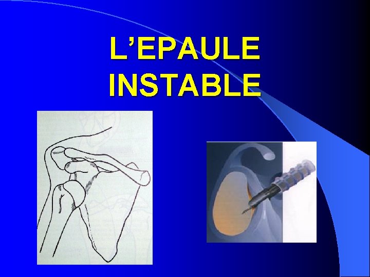 L’EPAULE INSTABLE 