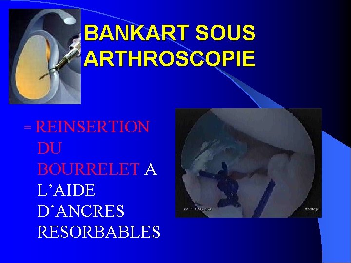 BANKART SOUS ARTHROSCOPIE = REINSERTION DU BOURRELET A L’AIDE D’ANCRES RESORBABLES 