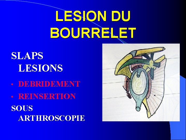 LESION DU BOURRELET SLAPS LESIONS DEBRIDEMENT • REINSERTION SOUS ARTHROSCOPIE • 