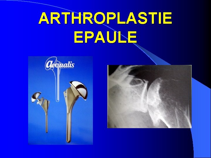 ARTHROPLASTIE EPAULE 