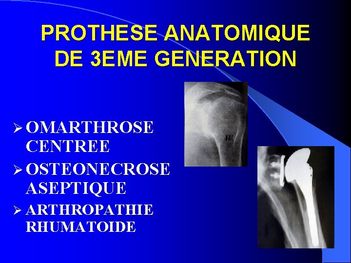 PROTHESE ANATOMIQUE DE 3 EME GENERATION Ø OMARTHROSE CENTREE Ø OSTEONECROSE ASEPTIQUE Ø ARTHROPATHIE