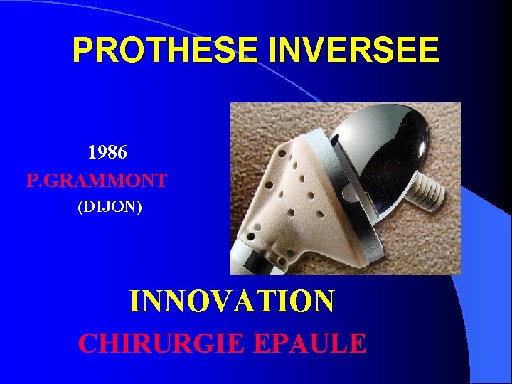 PROTHESE INVERSEE 1986 P. GRAMMONT (DIJON) INNOVATION CHIRURGIE EPAULE 