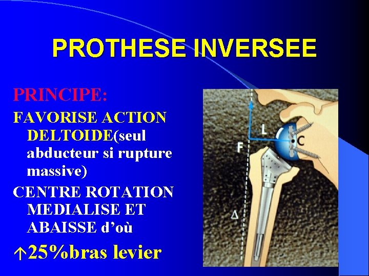 PROTHESE INVERSEE PRINCIPE: FAVORISE ACTION DELTOIDE(seul abducteur si rupture massive) CENTRE ROTATION MEDIALISE ET