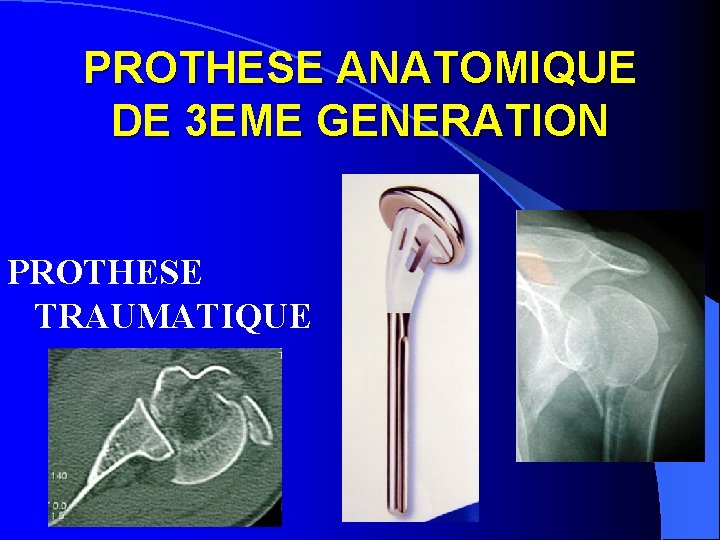 PROTHESE ANATOMIQUE DE 3 EME GENERATION PROTHESE TRAUMATIQUE 