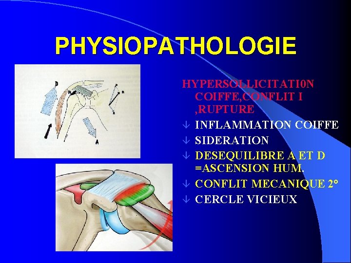 PHYSIOPATHOLOGIE HYPERSOLLICITATI 0 N COIFFE, CONFLIT I , RUPTURE â INFLAMMATION COIFFE â SIDERATION