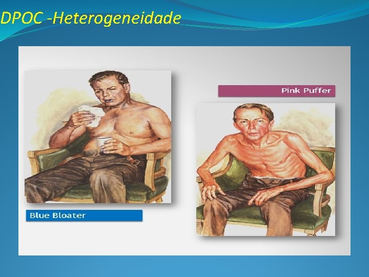 DPOC -Heterogeneidade 