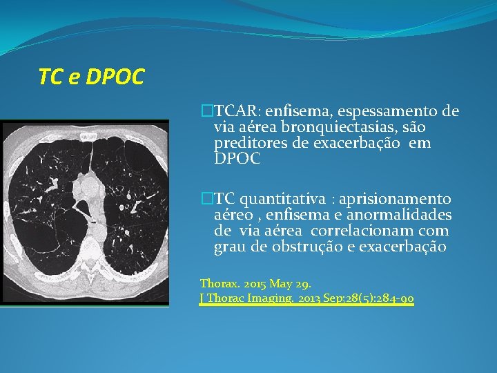 TC e DPOC �TCAR: enfisema, espessamento de via aérea bronquiectasias, são preditores de exacerbação