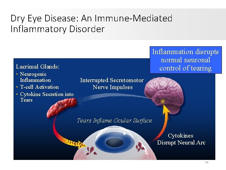 Dry Eye Disease: An Immune-Mediated Inflammatory Disorder Inflammation disrupts normal neuronal control of tearing