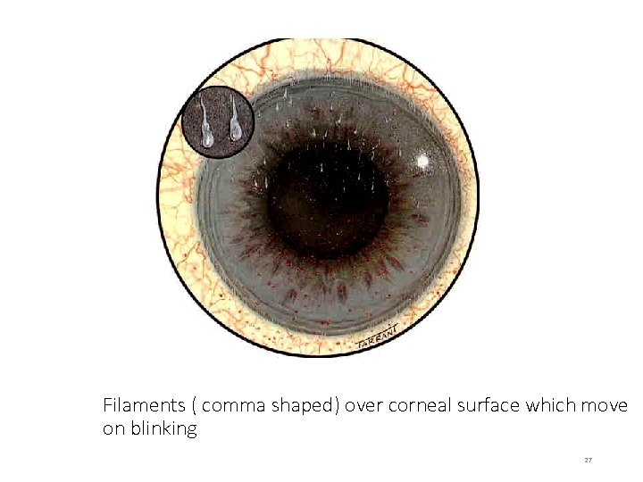 Filaments ( comma shaped) over corneal surface which move on blinking 27 