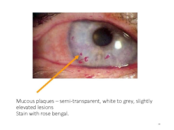 Mucous plaques – semi-transparent, white to grey, slightly elevated lesions Stain with rose bengal.