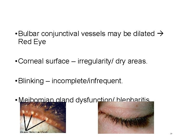  • Bulbar conjunctival vessels may be dilated Red Eye • Corneal surface –