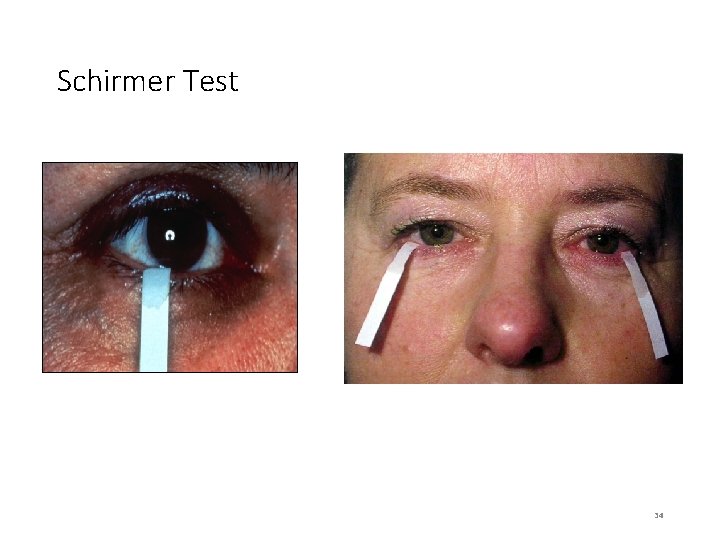 Schirmer Test 34 