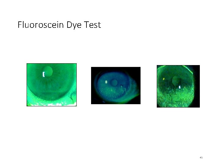 Fluoroscein Dye Test 41 